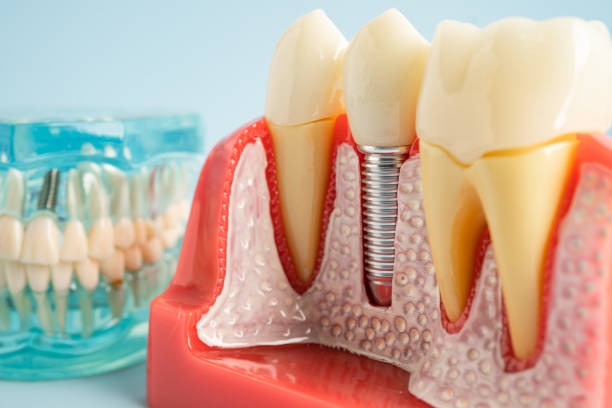 Best Dental Fillings (Composite and Amalgam)  in Gateway, FL